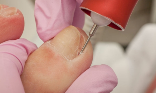 Tratamiento de uña encarnada