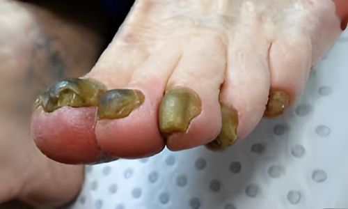 Tratamiento de hongos en pies y uñas