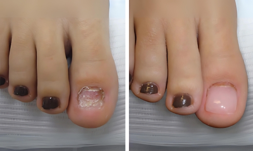 Reconstrucción de uñas